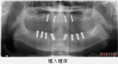 不良情绪对做借卵生子供卵试管成功率的影响有多大？你需要摧毁它