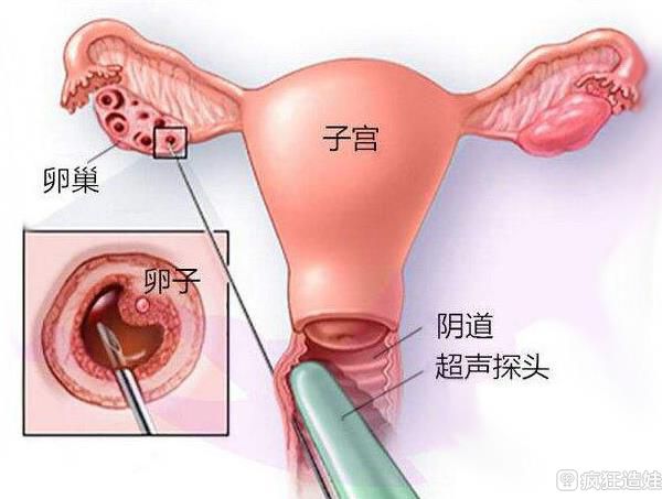 婴儿会在借卵做试管中成长吗？朱伟博士告诉你答案