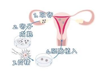 吉林第三代做借卵试管婴儿国内价格