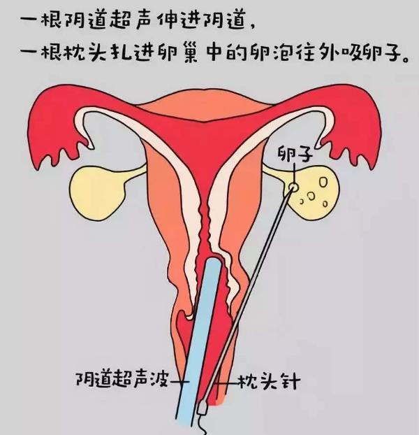 做试管婴儿提前准备什么提高受孕率
