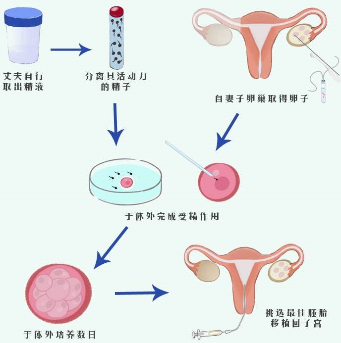 供卵代怀老公给打针